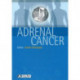 Adrenal Cancer