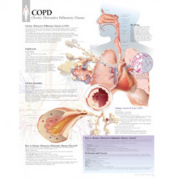 COPD (Chronic Obstructive Pulmonary Disease) Laminated Poster