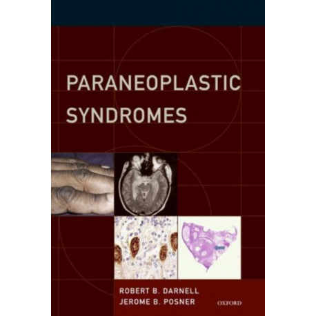 Paraneoplastic Syndromes