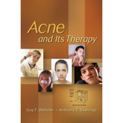 Acne and Its Therapy