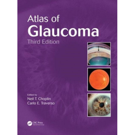 Atlas of Glaucoma