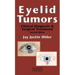 Eyelid Tumors