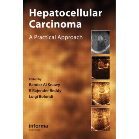 Hepatocellular Carcinoma: A Practical Approach
