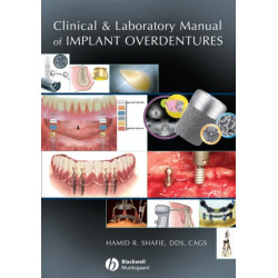 Clinical and Laboratory Manual of Implant Overdentures