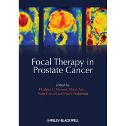 Focal Therapy in Prostate Cancer