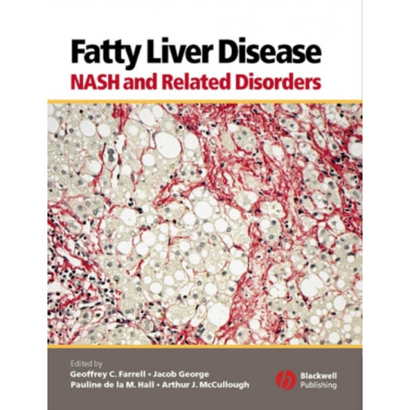 Fatty Liver Disease: NASH and Related Disorders
