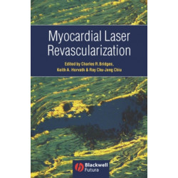 Myocardial Laser Revascularization