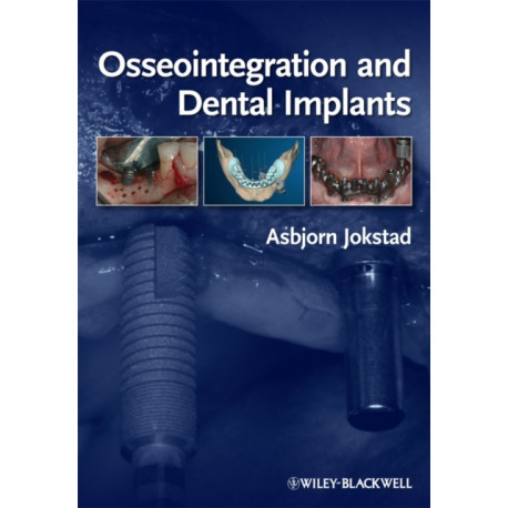 Osseointegration and Dental Implants