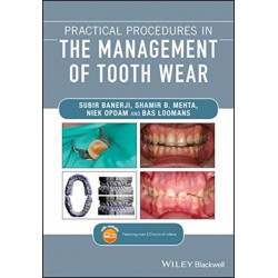 Practical Procedures in the Management of Tooth Wear