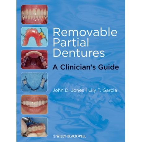 Removable Partial Dentures: A Clinician's Guide