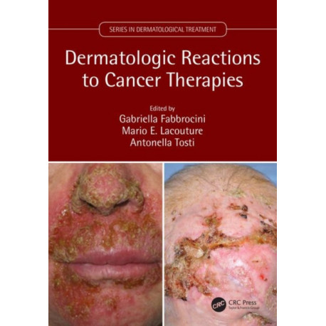 Dermatologic Reactions to Cancer Therapies