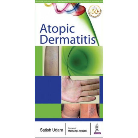 Atopic Dermatitis