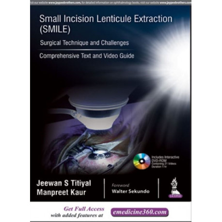 Small Incision Lenticule Extraction (SMILE): Surgical Technique and Challenges: Comprehensive Text and Video Guide