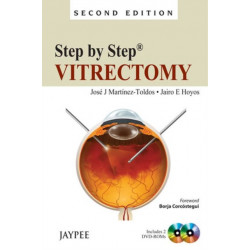 Step by Step: Vitrectomy