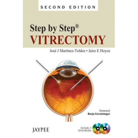 Step by Step: Vitrectomy