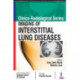 Clinico Radiological Series: Imaging of Interstitial Lung Diseases