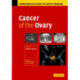 Cancer of the Ovary