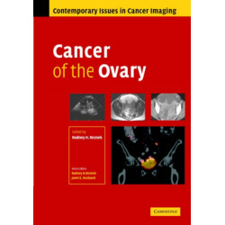 Cancer of the Ovary