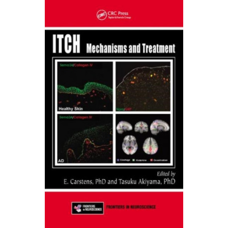 Itch: Mechanisms and Treatment
