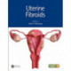 Uterine Fibroids