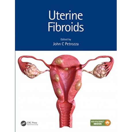 Uterine Fibroids
