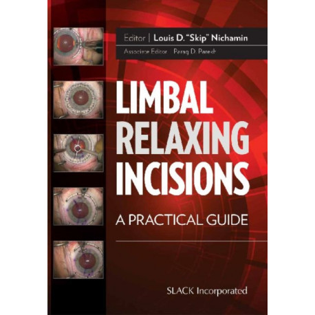 Limbal Relaxing Incisions: A Practical Guide