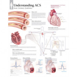 Understanding ACS (Acute Coronary Syndrome) Paper Poster