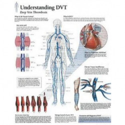 Understanding DVT Paper Poster