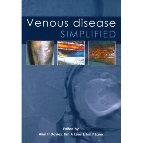 Venous Disease Simplified
