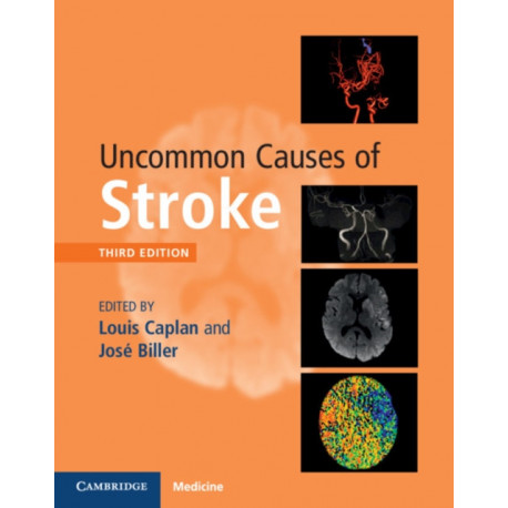 Uncommon Causes of Stroke