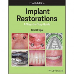 Implant Restorations: A Step-by-Step Guide