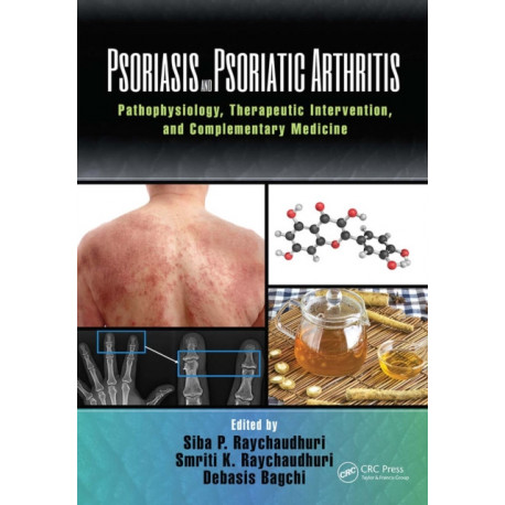 Psoriasis and Psoriatic Arthritis: Pathophysiology, Therapeutic Intervention, and Complementary Medicine