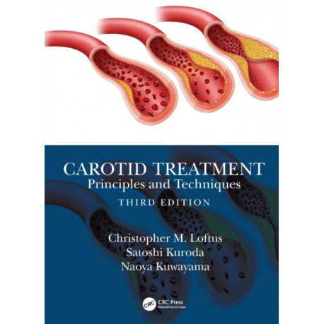 Carotid Treatment: Principles and Techniques