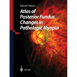 Atlas of Posterior Fundus Changes in Pathologic Myopia
