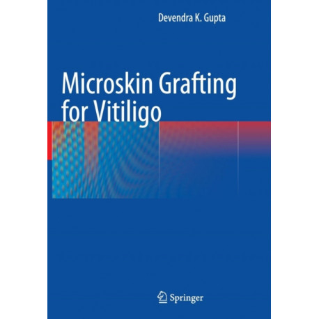 Microskin Grafting for Vitiligo