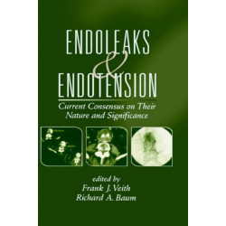 Endoleaks and Endotension: Current Consensus on Their Nature and Significance