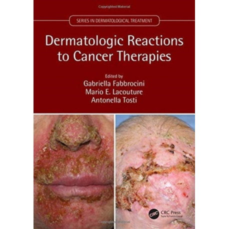 Dermatologic Reactions to Cancer Therapies