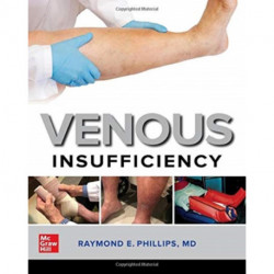 Venous Insufficiency