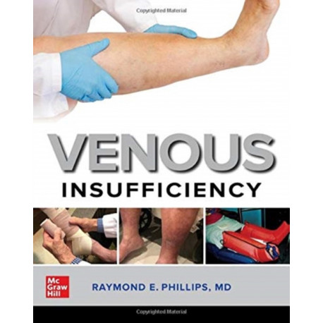 Venous Insufficiency