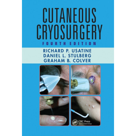 Cutaneous Cryosurgery: Principles and Clinical Practice
