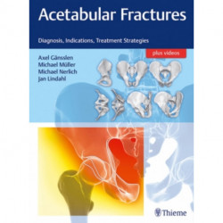 Acetabular Fractures: Diagnosis, Indications, Treatment Strategies