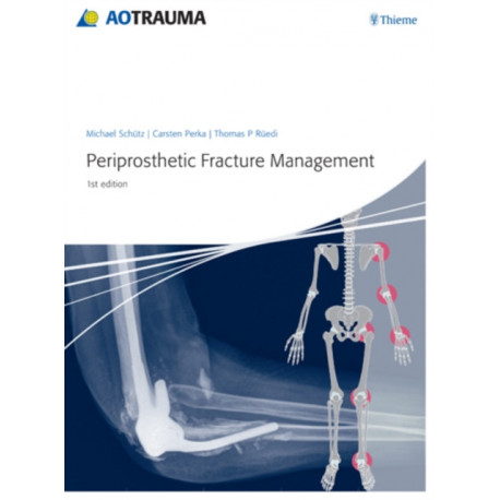 Periprosthetic Fracture Management