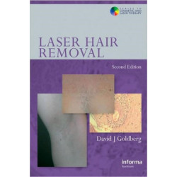 Laser Hair Removal