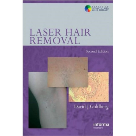 Laser Hair Removal