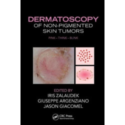 Dermatoscopy of Non-Pigmented Skin Tumors: Pink - Think - Blink