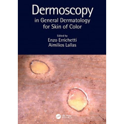 Dermoscopy in General Dermatology for Skin of Color