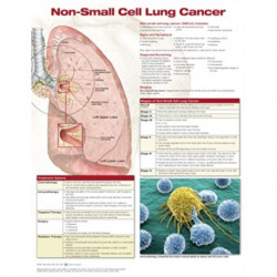 Non-Small Cell Lung Cancer, Chart Laminated