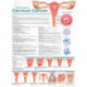 Understanding Cervical Cancer Anatomical Chart