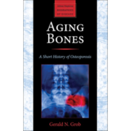 Aging Bones: A Short History of Osteoporosis