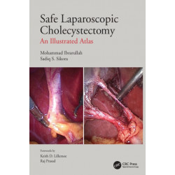 Safe Laparoscopic Cholecystectomy: An Illustrated Atlas